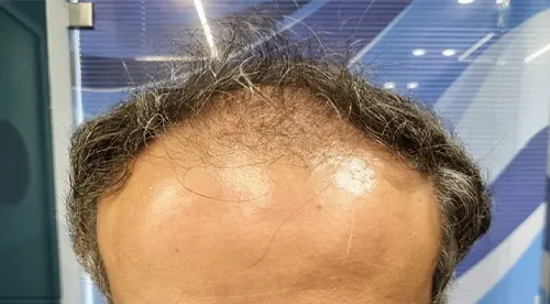 تصویر قبل از کلینیک تخصصی کاشت مو در شیراز | دکتر احسان صالح