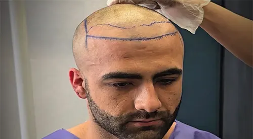تصویر قبل از کلینیک تخصصی کاشت مو در شیراز | دکتر احسان صالح